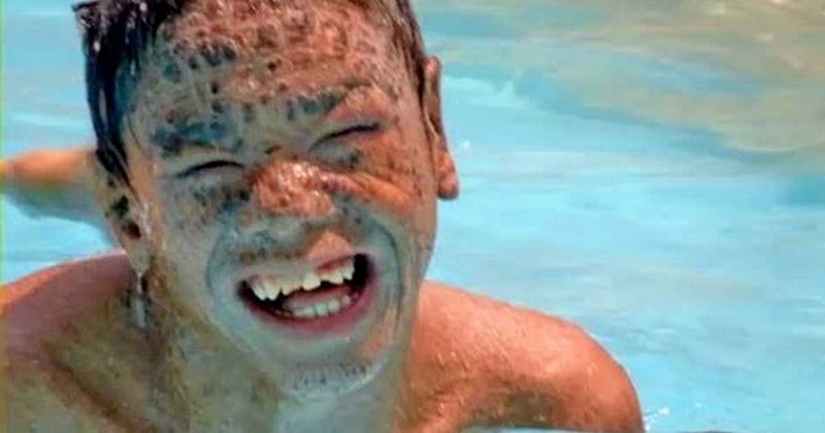 A Boy With A Rare Skin Condition Faces Daily Struggles With A NeverEnding Hope SF Globe