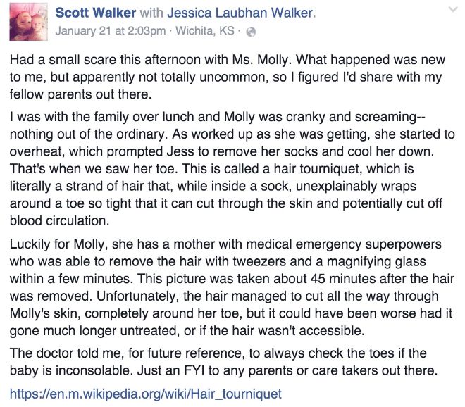 Parents notice something wrong with baby, discover hair wrapped around