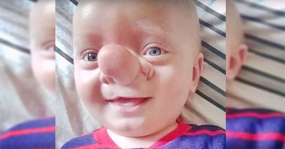 Birth defect results in boy's brain growing through his nose SF Globe