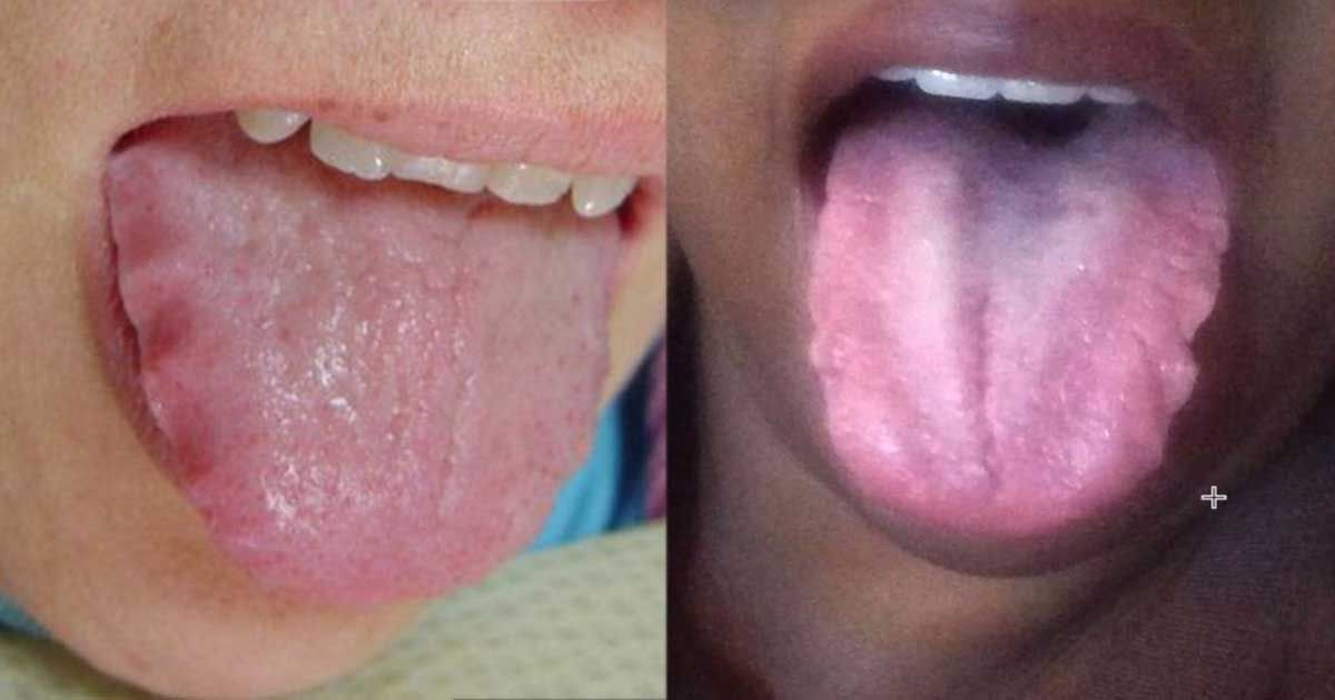 If you stick out your tongue and see these wavy edges, here's what it means