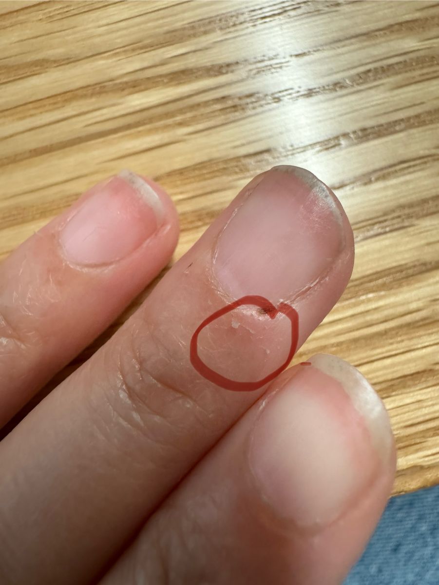 The skin around my fingernails keep peeling. What should I do?